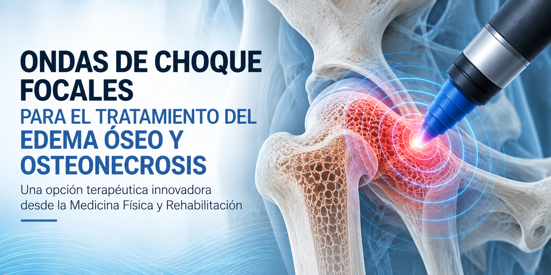 Ondas de choque focales para edema óseo y osteonecrosis